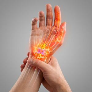 Carpal Tunnel Syndrome Illustration