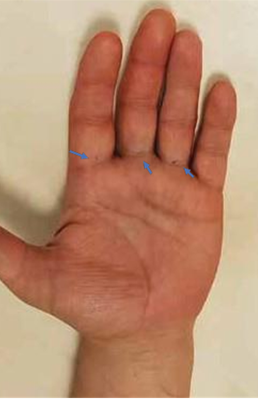 Multiple Keyhole Trigger Scars at once